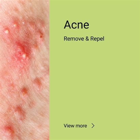 Acne - Remove & Repel – Ice's Secret