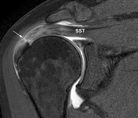 Supraspinatus Tear Mri