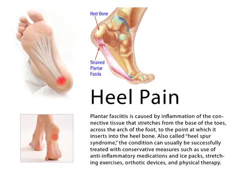 Calcaneal spur Homeopathic Treatment Heel pain Progressive damage