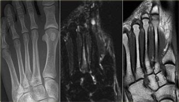 Mri Stress Fracture Grading