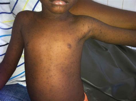 Image of the Week: Erythematous Rash and Fever - Clinical Advisor