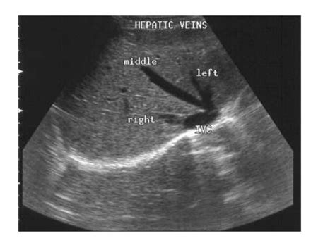 Liver Vasculature Ultrasound