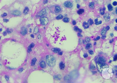 Histoplasmosis - PAS stain