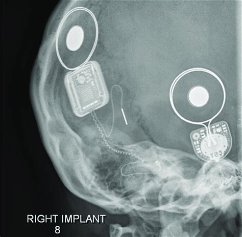 Modified Stenver's view of right cochlear implant with electrode tip... | Download Scientific ...