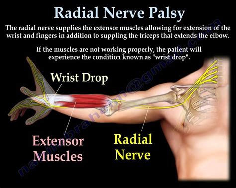 Radial Nerve Palsy, injury WRIST DROP Everything You Need To Know Dr Nabil Ebraheim - YouTube