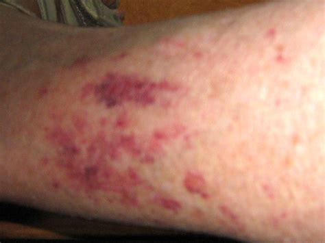 I have large dark red blotches on both legs- I can send a picture,