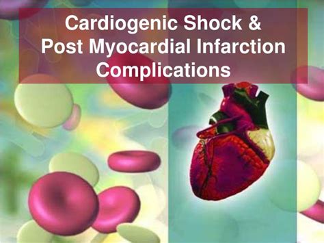 PPT - Cardiogenic Shock & Post Myocardial Infarction Complications ...