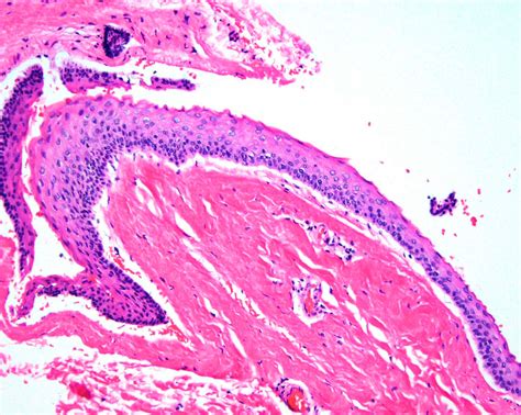 Steatocystoma multiplex