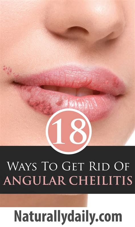 18 Quick Home Remedies for Angular Cheilitis - Naturally Daily