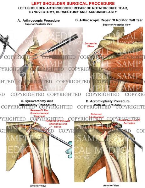 Left Shoulder RC, synovectomy, bursectomy, acromiplasty — Medical Art Works