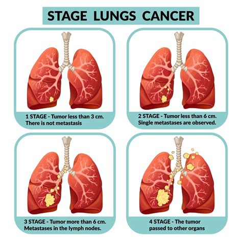 Stage 4 Lung Cancer Treatments - CancerProTalk.com