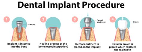 Dental Implant Procedure - Maltepe Dental Clinic