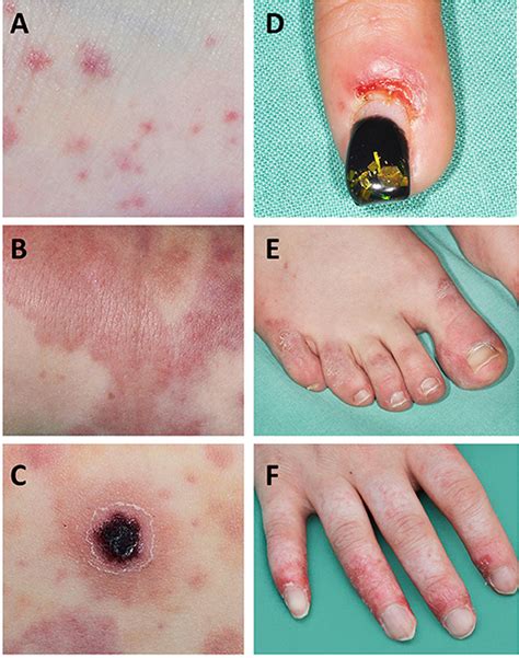 Frontiers | Vasculitis in Juvenile-Onset Systemic Lupus Erythematosus