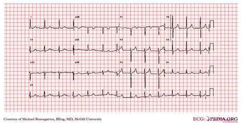 First degree AV block EKG examples - wikidoc