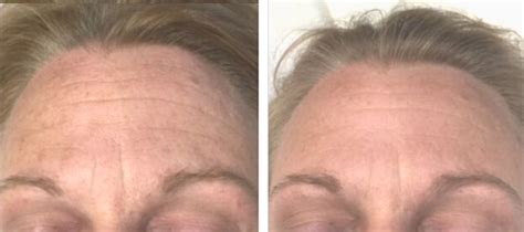 New SkinStylus® Microneedling Before & After Photos - AMAE Med Spa - Birmingham, MI