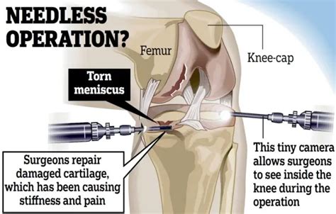 Knee cartilage repair surgery: recovery time & aftercare