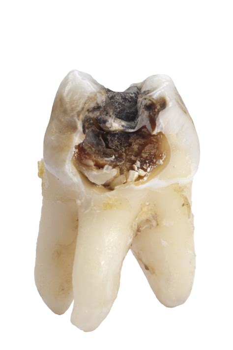 Posted 11 years ago Tooth Pain , Tooth Restorations