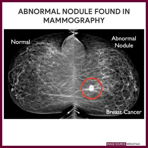 Mammography (Mammogram) - Nursing Responsibilities - Nurseslabs