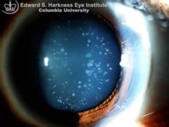 Medicine Decoded: Cataracts-Few interesting types