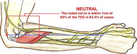 Radial Nerve Entrapment