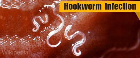 Hookworm Infection - Causes, Symptoms, Diagnosis, Treatment and Prevention