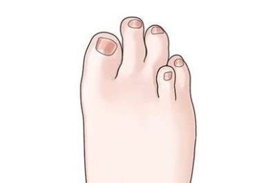 Brachymetatarsia | Foot & Podiatry Surgery