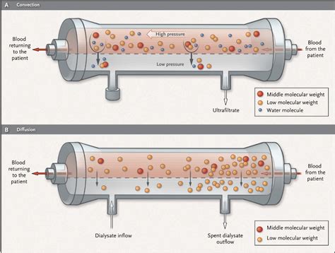 Hemodialysis Vs Hemofiltration - Lepu Medical Technology(Beijing)Co.,Ltd.