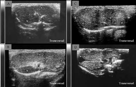 Liver echogenicity patterns: [5A] Pattern 0 [5B] Pattern 1 [5C] Pattern ...