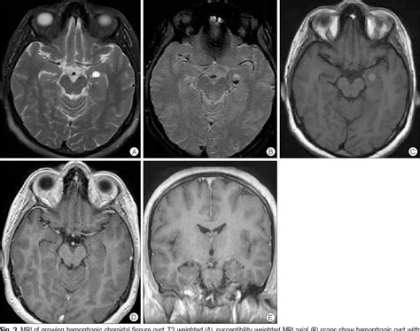 Figure 2 from Growing Hemorrhagic Choroidal Fissure Cyst | Semantic Scholar