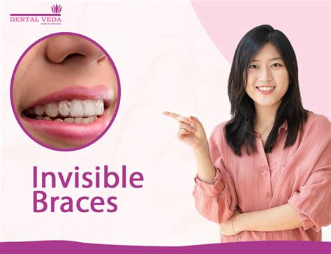 Invisible Braces For Teeth - What and How They Work