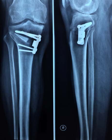 VARUS KNEE OSTEOARTHRITIS - CORRECTIVE TIBIAL OSTEOTOMY | GEORGE D. GOUDELIS MD. Ph.D.