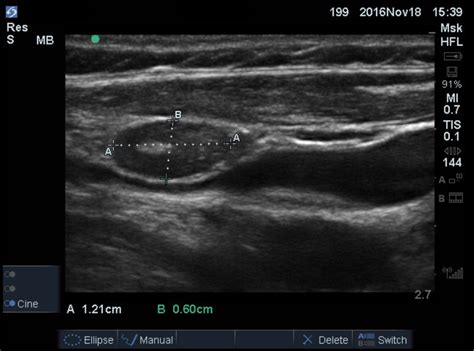 Reactive Lymph Nodes In Neck Ultrasound