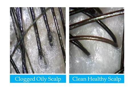 Scalp Detox and Scalp Disorders Treatments | Regain Healthy Scalp