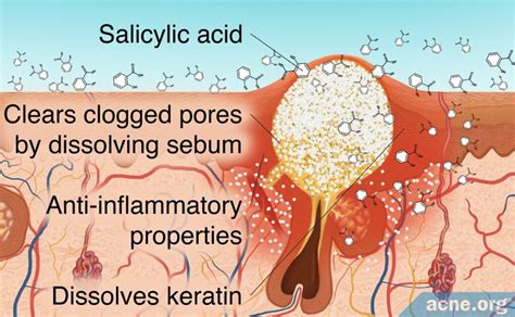 Salicylic Acid - Acne.org