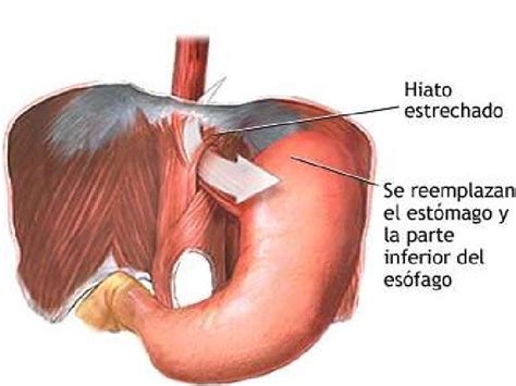 Hernia de hiato