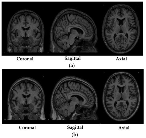 3d brain mri classification