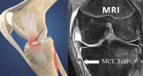 MCL Reconstruction - Arthromed - Arthroscopy & Joint Replacement Centre ...