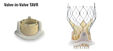 TAVR Branches Out: New Refinements, Broader Indications - Advances in ...