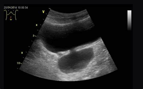 Diverticulum Of Bladder Ultrasound