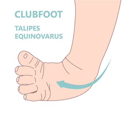 4 Critical Signs of Clubfoot in Newborns | Vejthani