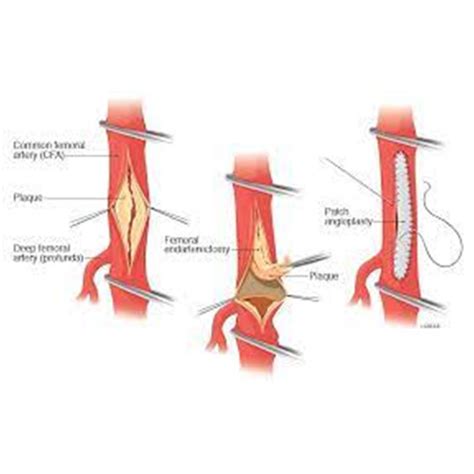 Springfield Heart Surgeons LLC - Femoral Endarterectomy