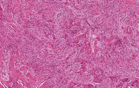 Peripheral Ossifying Fibroma Histology