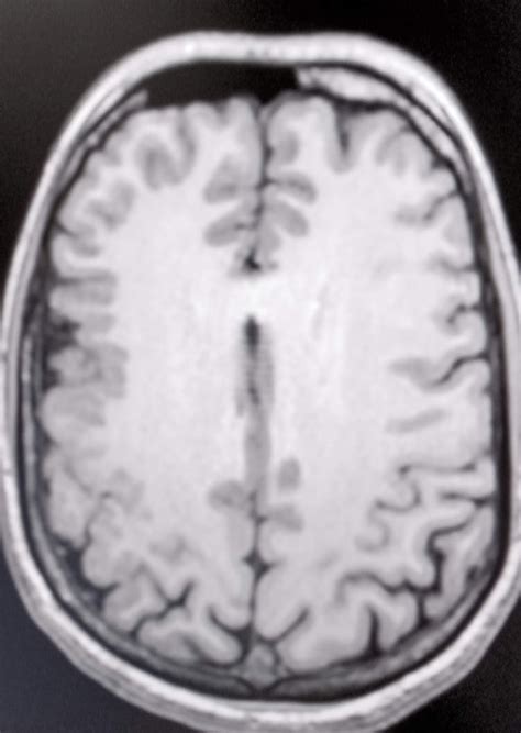 Polymicrogyria : MRI Teaching Case - Sumer's Radiology Blog