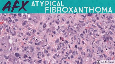 Atypical Fibroxanthoma (AFX) vs Pleomorphic Dermal Sarcoma (PDS): 5 ...