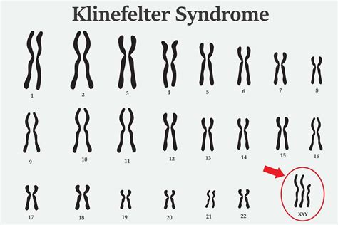 Le syndrome de Klinefelter, qu’est-ce que c’est ? - TrendRadars Français