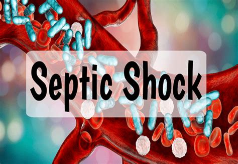 Septic Shock: Causes, Symptoms and Nursing Management