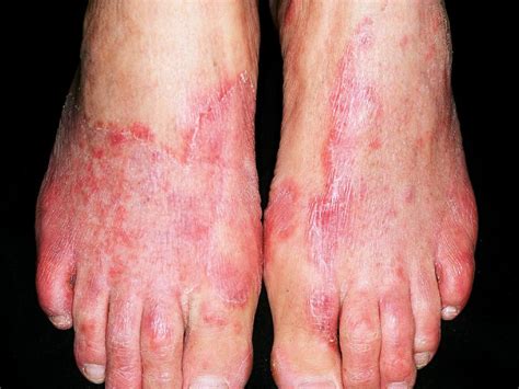 Tinea Pedis Article