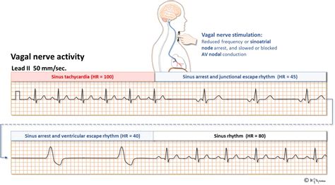 Sinus arrest and sino-atrial block (SA block)