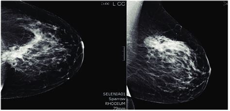 Mammogram. A core biopsy was done of this mass and it showed poorly... | Download Scientific Diagram