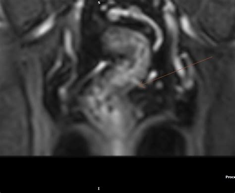 MR Enterography : Crohn's Disease - Sumer's Radiology Blog